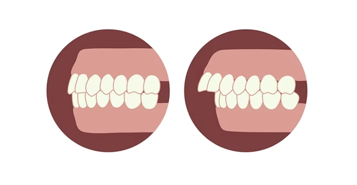 Overbite Correction 2